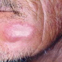 
	Follicular mucinosis - benign&nbsp;