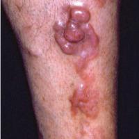 
	Diffuse large B-cell lymphoma