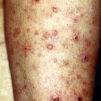 
	Lymphomatoid papulosis