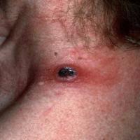 
	Lymphomatoid papulosis: close-up