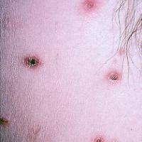 
	Lymphomatoid papulosis