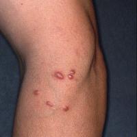 
	Marginal zone lymphoma