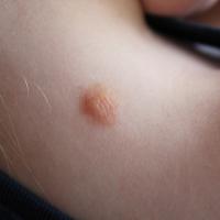 
	Mastocytoma