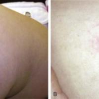 
	Mastocytoma - Darier's sign
