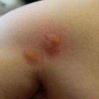 
	Solitary mastocytoma in a young child