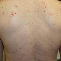 
	Maculopapular cutaneous mastocytosis