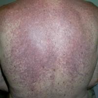 
	Maculopapular cutaneous mastocytosis