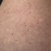 Maculopapular cutaneous mastocytosiseCopied with…
