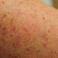 
	Same patient as previous image