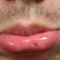 
	Mucosal melanocytic macule 