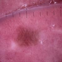 
	Dermoscopic appearance of figure 1