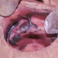 
	Melanoma