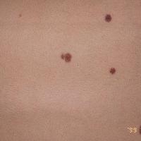 Common benign melanocytic naevi - acquired&nbsp;