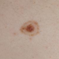 
	Cockade naevus