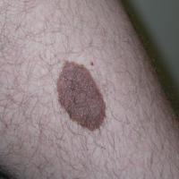
	Congenital melanocytic naevus