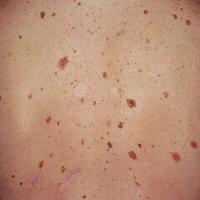 Atypical melanocytic naevi&nbsp;