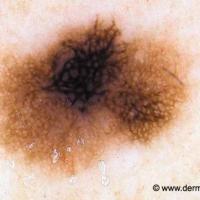 Melanoma with clue -&nbsp;an atypical pigment…