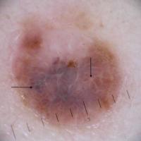 Melanoma clue - a negative network&nbsp;