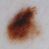 Melanoma with clue -&nbsp;an&nbsp;atypical…