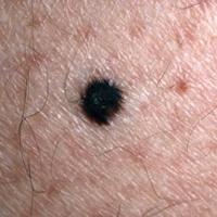 Melanoma in situA = Asymmetry of shapeB = Border,…