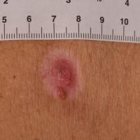 Hypomelanotic melanoma&nbsp;A largely pink…