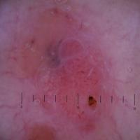 Dermoscopic image of the previous figure -…