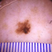 Melanoma with chaos - as defined by&nbsp;variable…