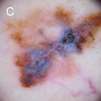 Melanoma clue - shiny white…