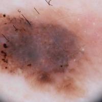 Melanoma clue - atypical globulesVariation in…