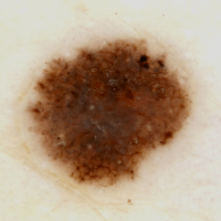Melanoma clue - peripheral black dots and globules