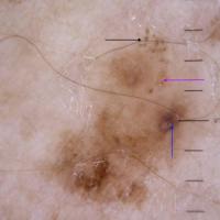 Melanoma clue -&nbsp;atypical…