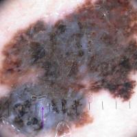 Melanoma clue -&nbsp;blue-white veil