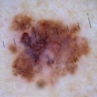 Melanoma clue - regression structuresBlue/grey…