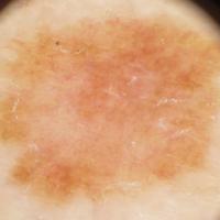 Melanoma clue - eccentric&nbsp;structureless…