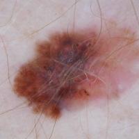 Melanoma clue -&nbsp;eccentric structureless…