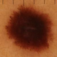 Melanoma clue - a large structureless areaWhile…
