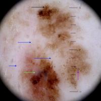 Melanoma with chaotic structures&nbsp;In an…