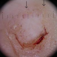 Nodular melanoma, hypomelanoticVery few…