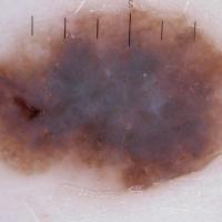 Melanoma clue - blue-white veilNodular melanomas…