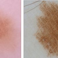 Melanoma clue - accentuated skin surface markings