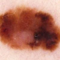 Melanoma with chaos - as defined by colourCopied…