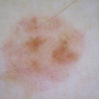 Melanoma with ''chaos'' - as defined by…