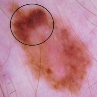 Melanoma with clue - an atypical pigment…