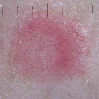 Melanoma - atypical vesselsDotted vessels can be…