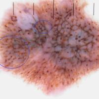 Melanoma clue - beaded appearanceCopied with kind…
