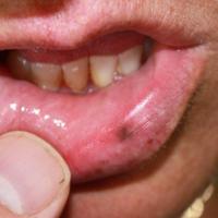 Mucosal melanocytic maculeBenignCopied with kind…