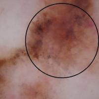 Melanoma clue - regression structuresFine…