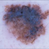 Melanoma clue - blue-white veilCopied with kind…