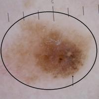 Melanoma with chaos - as defined by variable…