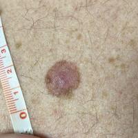 Melanoma - disorganised pink and brownCopied with…